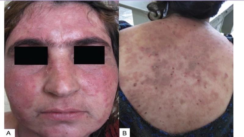 Gợi ý thực đơn cho người bị nấm mặt kiêng ăn gì