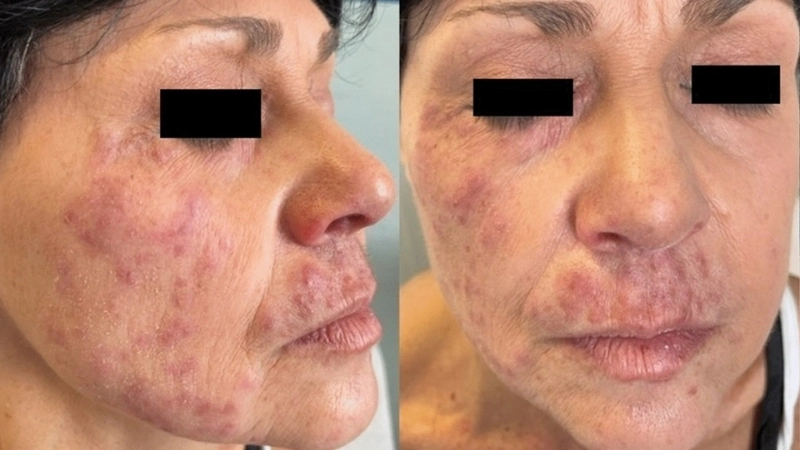 Hướng dẫn cách trị nấm da mặt tại nhà an toàn