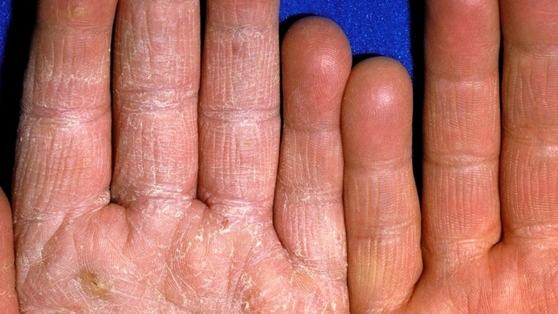 Tổn thương đặc trưng của nấm kẽ ngón tay gây ngứa và nứt da