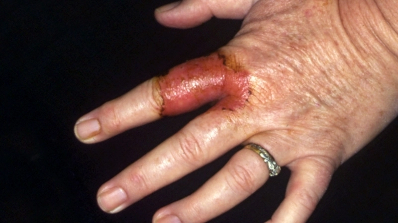 Cách phân biệt nấm và tổ đỉa qua hình thái mụn nước