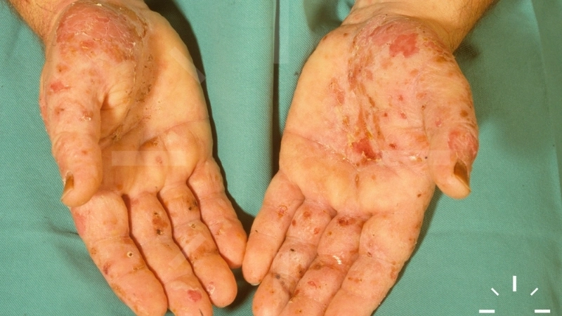 Phân tích các nguyên nhân bị nấm da tay trong sinh hoạt hàng ngày