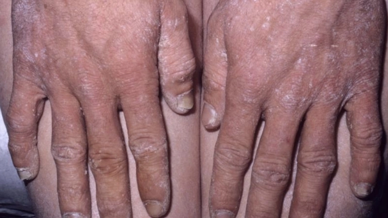 Hình ảnh nấm lây lan sang móng và cần thuốc trị nấm móng tay