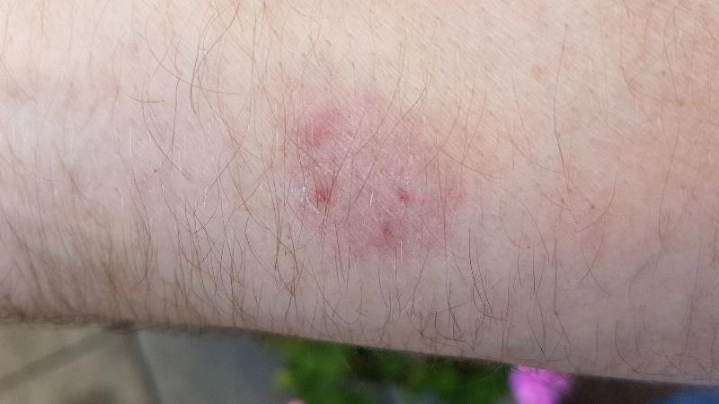 Hình ảnh nấm móng tay ở trẻ