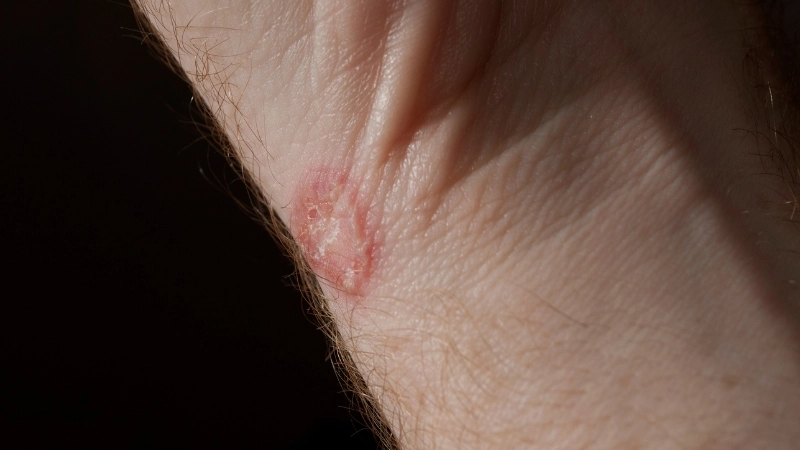 Tổng hợp hình ảnh các loại bệnh nấm da phổ biến