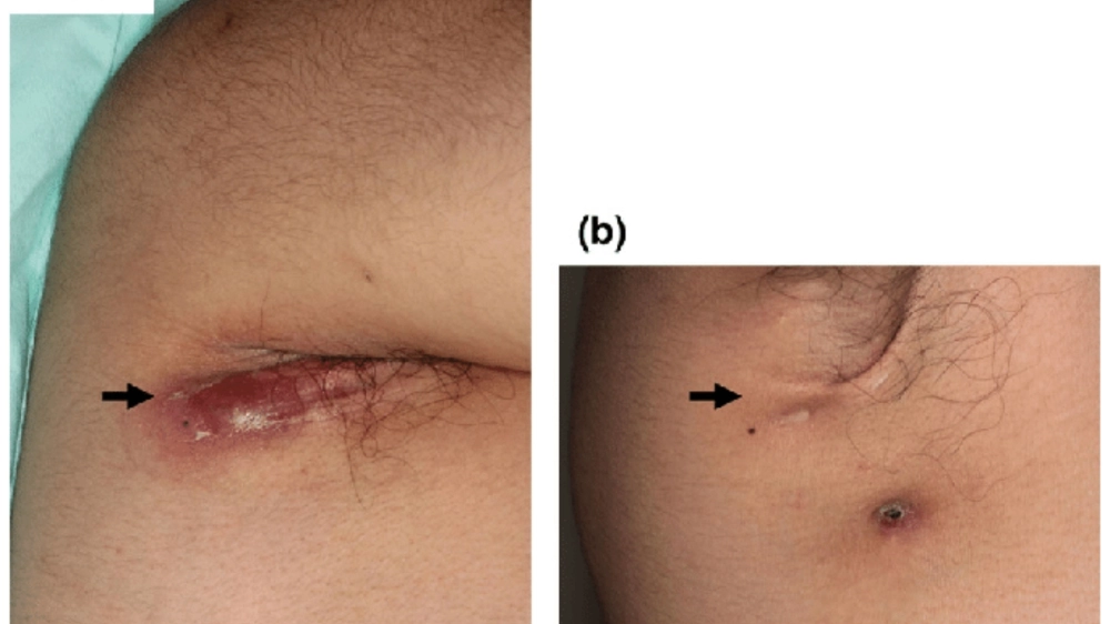 Tình trạng áp xe nách cần can thiệp y tế