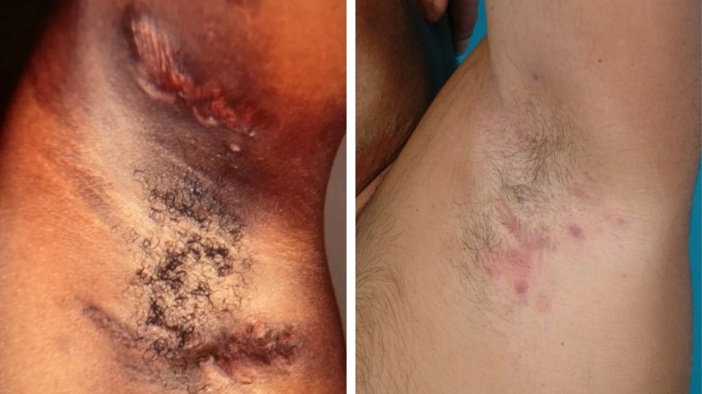 Các nguyên nhân bị ổ gà ở nách thường gặp