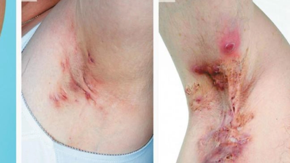 Một số loại thuốc bôi trị ổ gà ở nách