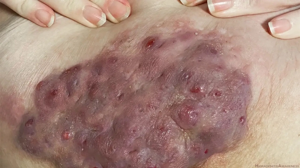 Hình ảnh viêm nang lông ở nách bị sưng đỏ