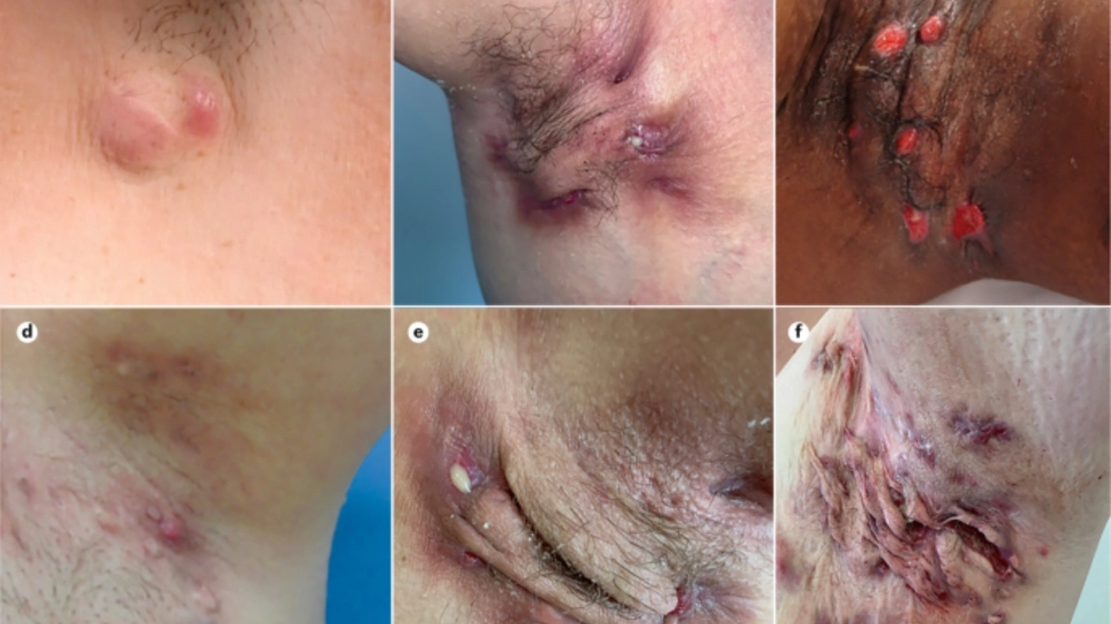 Biến chứng sẹo sau khi trị bệnh ổ gà ở nách