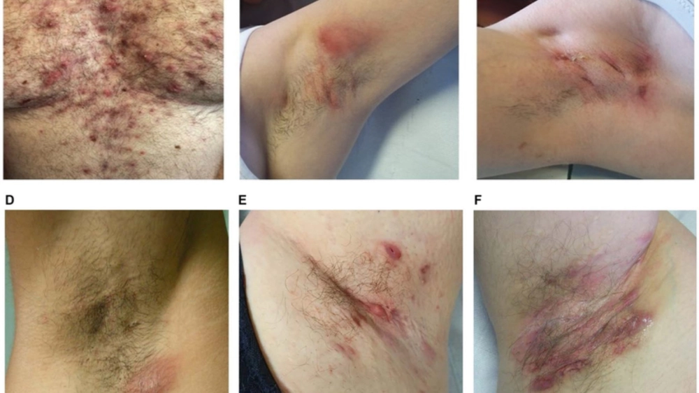 Hình ảnh mụn nhọt ở nách có chứa mủ