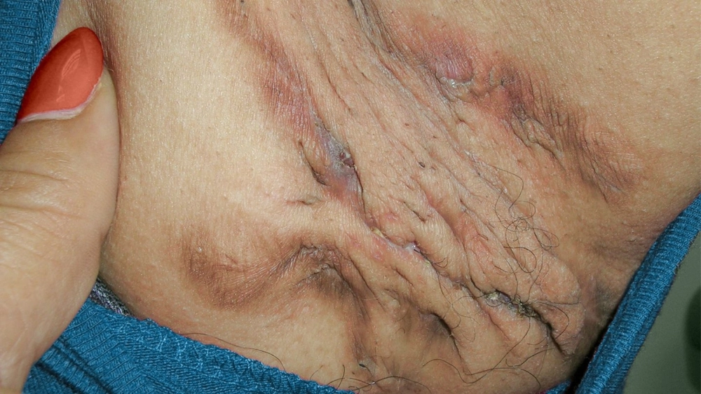 Sơ đồ minh họa các nguyên nhân bị ổ gà ở nách