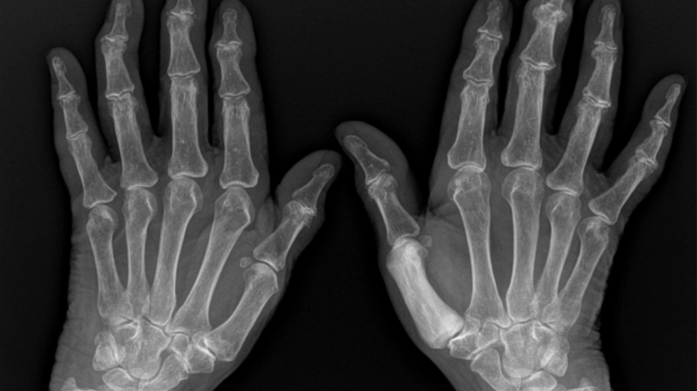 Hình ảnh tổn thương da điển hình của bệnh Paget vú