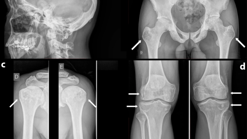 Minh họa cách điều trị bệnh Paget bằng phẫu thuật