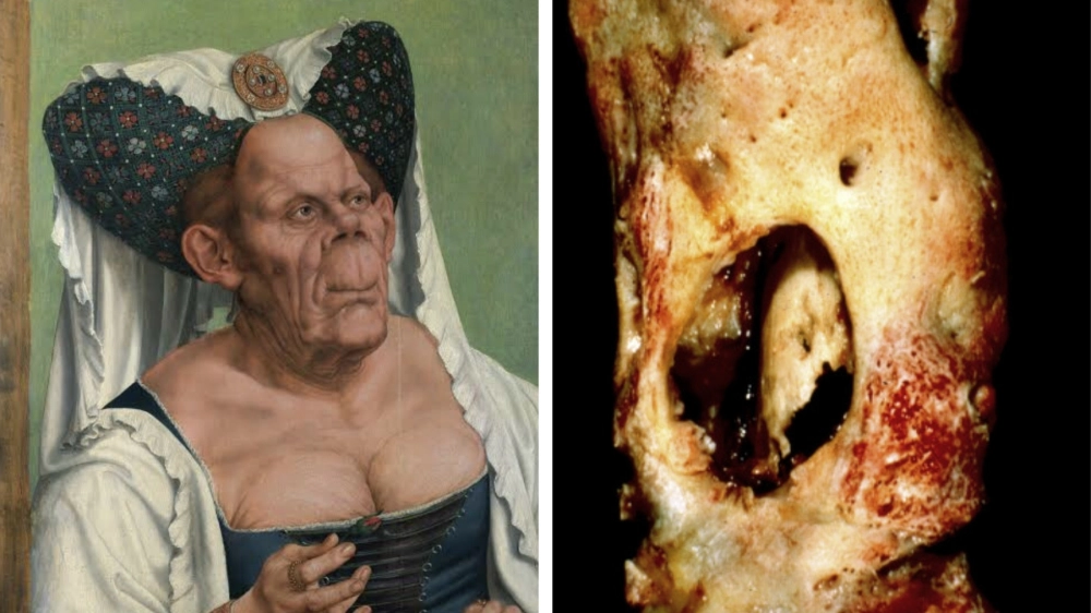 Hình ảnh tế bào học của ung thư vú dạng Paget