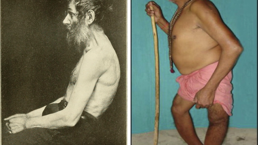 Hộp sọ bị ảnh hưởng bởi bệnh Paget xương