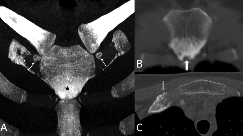 X-quang cho thấy sự biến dạng của bệnh Paget xương