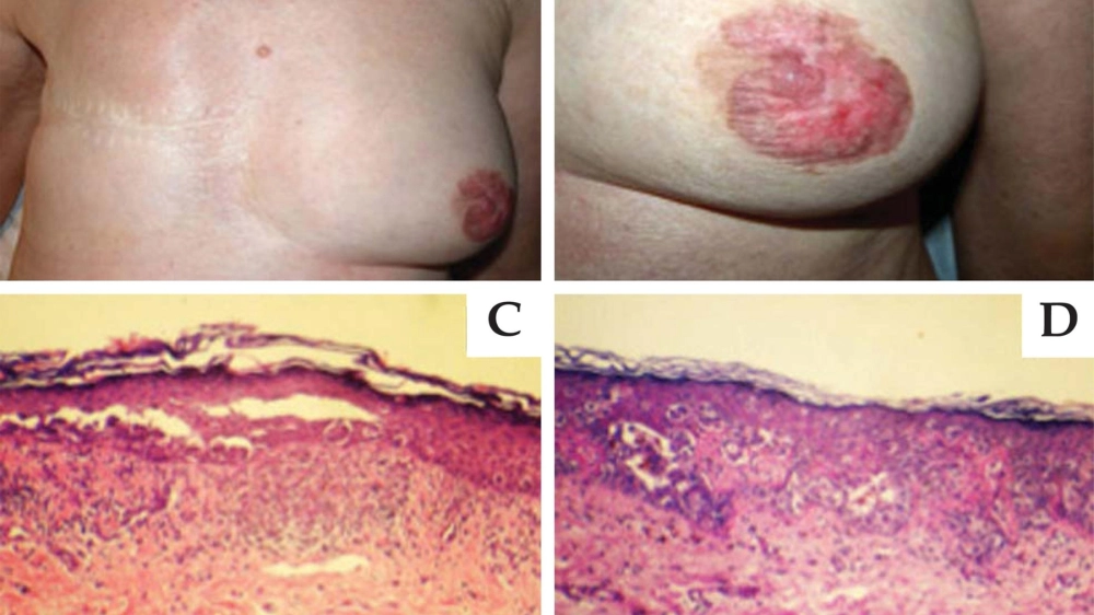 Thuốc bisphosphonate là cách điều trị bệnh Paget xương