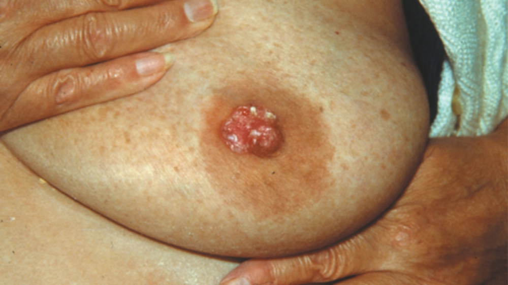 Núm vú bị tụt vào trong là một triệu chứng bệnh Paget