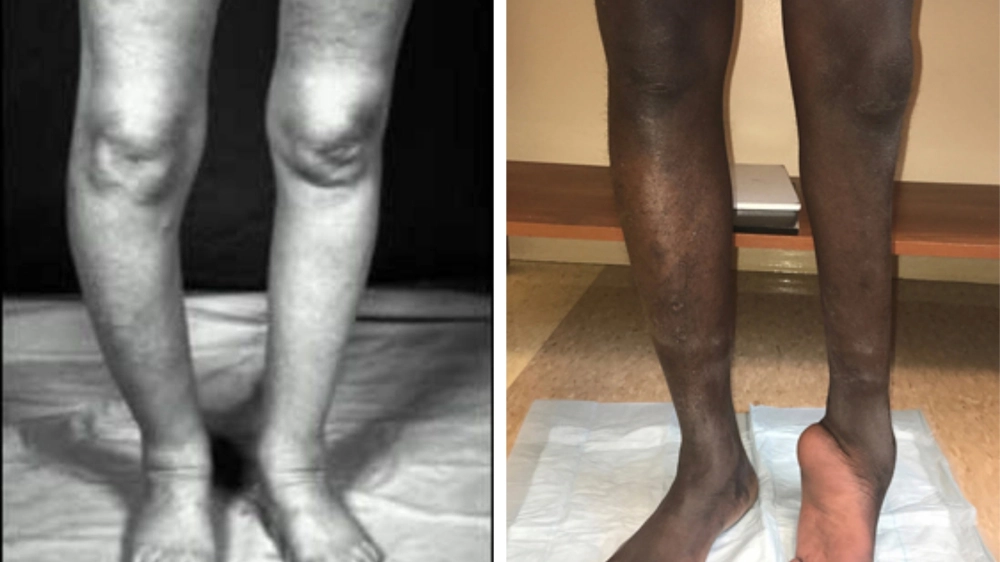 Hình ảnh lâm sàng điển hình giúp nhận biết triệu chứng bệnh Paget.