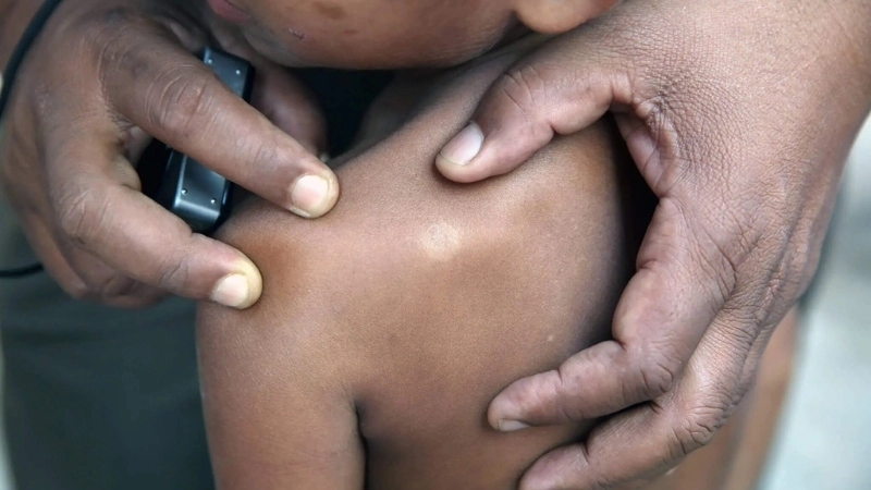 Hình ảnh bệnh hủi với các tổn thương da ban đầu