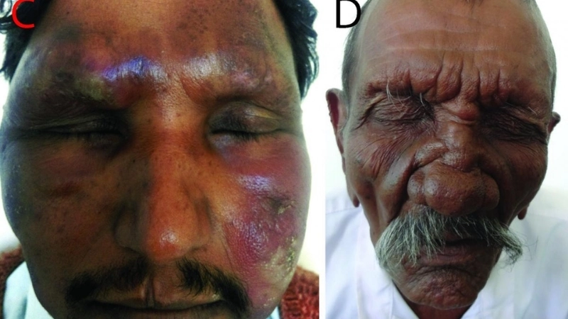 Hình ảnh vi khuẩn hansen dưới kính hiển vi điện tử