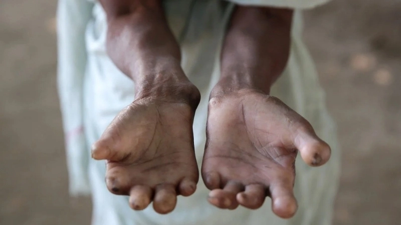 Cuộc sống bên trong một trại phong ngày nay