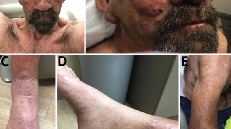 Những dấu hiệu bệnh phong sớm cần được nhận biết