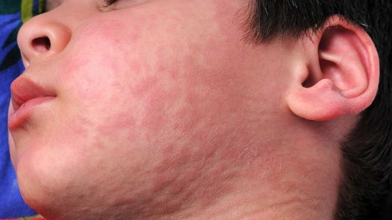 So sánh hình ảnh bệnh mề đay mẩn ngứa và các bệnh da liễu khác