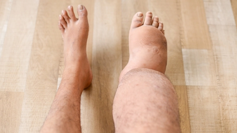 Giải đáp: bệnh phù chân voi có chữa được không