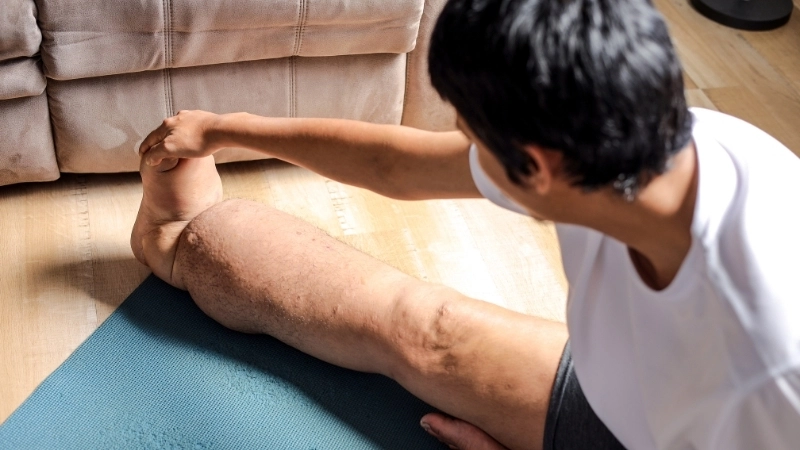 Hình ảnh chân bị phù nề điển hình