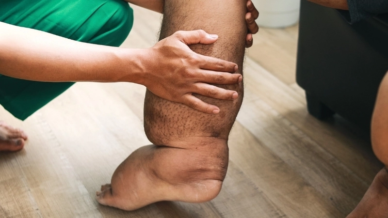 Chương trình phòng chống bệnh giun chỉ bạch huyết quốc gia