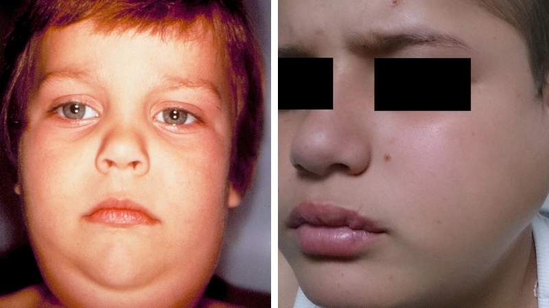 Hình ảnh lọ vắc xin quai bị (MMR)