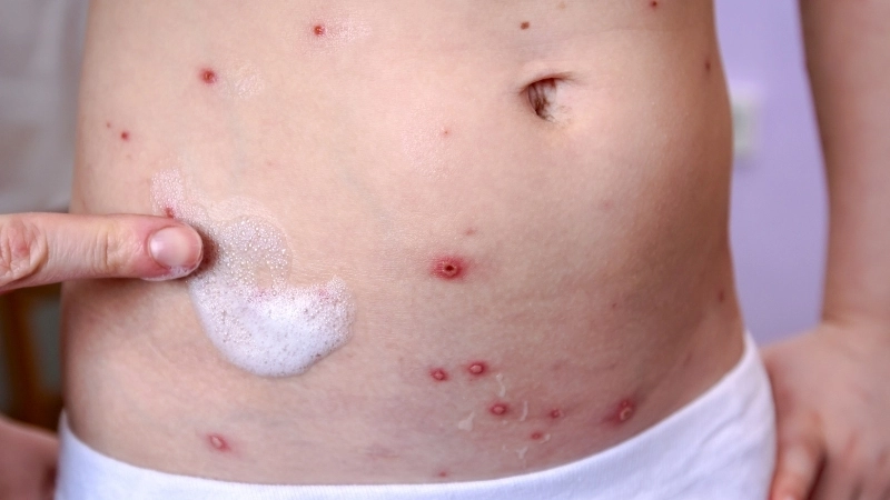 Nguy cơ của bệnh rubella ở bà bầu