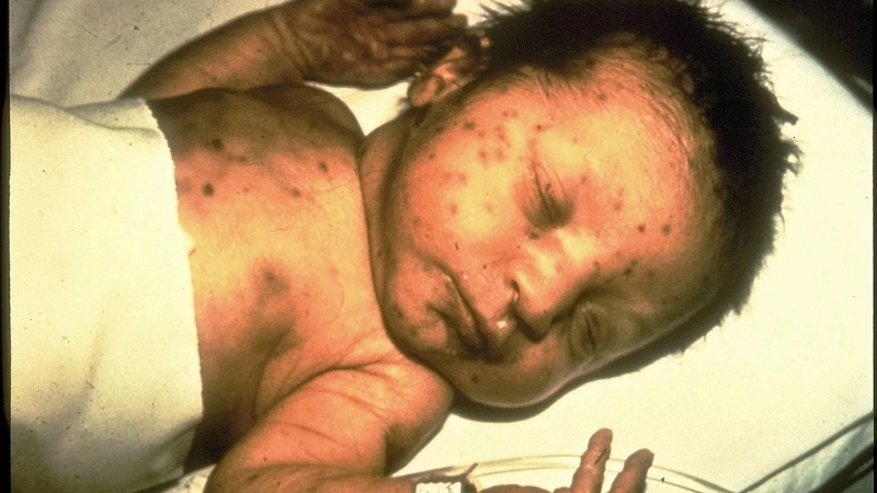 Lịch tiêm vắc xin rubella cho trẻ em và người lớn