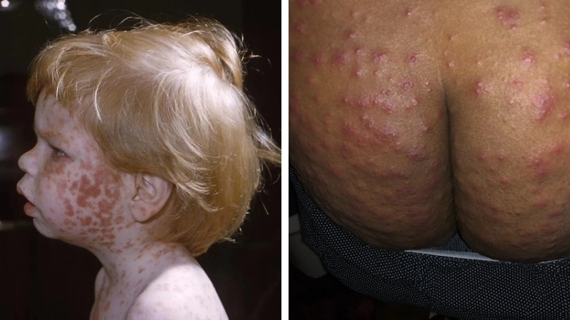Giải đáp rubella có nguy hiểm không