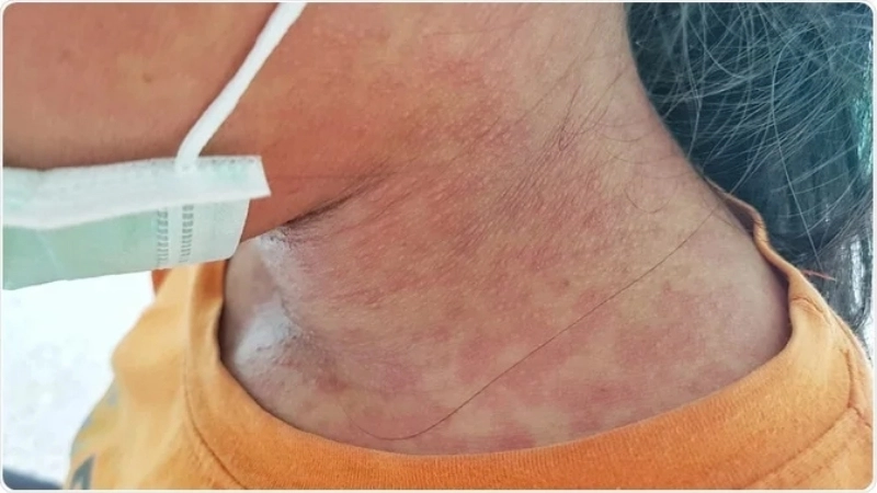 Biểu hiện bệnh rubella ở trẻ em