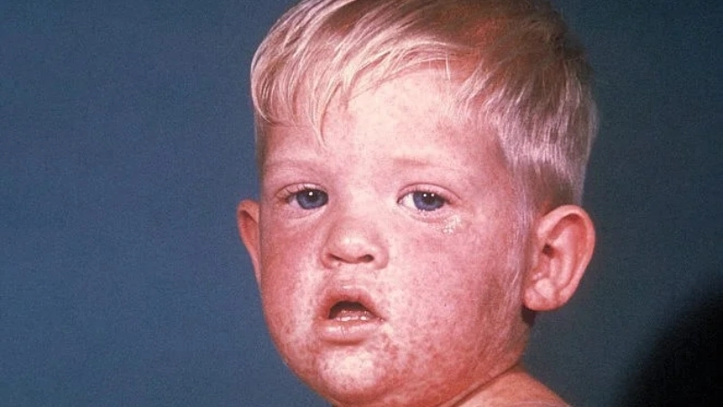 Hình ảnh phát ban Rubella trên da mặt