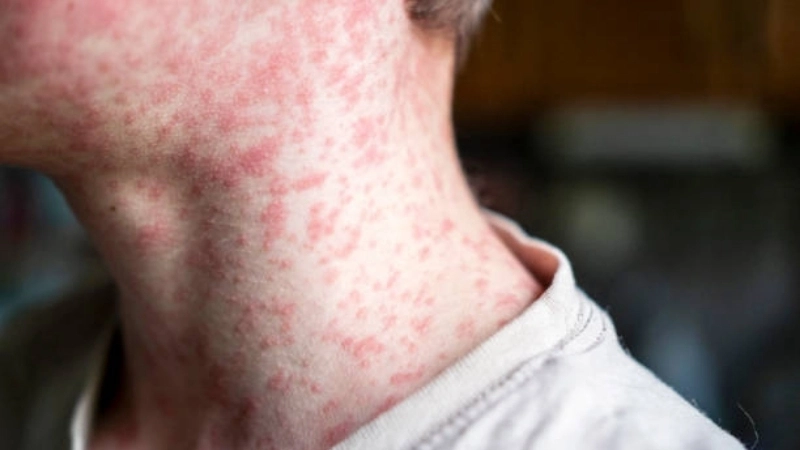 Sưng hạch bạch huyết sau tai do Rubella