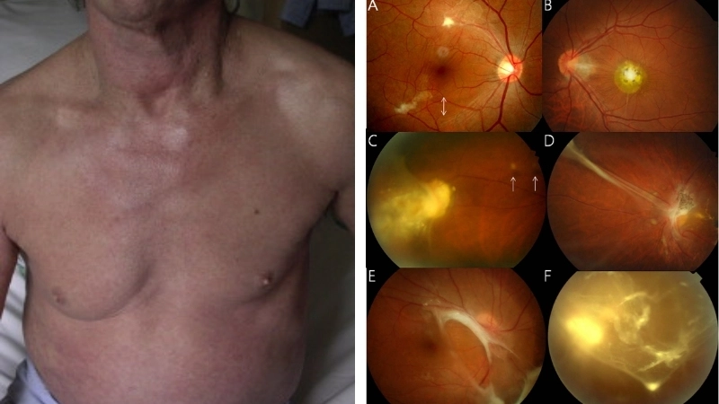 Giải đáp bệnh sán chó có nguy hiểm không