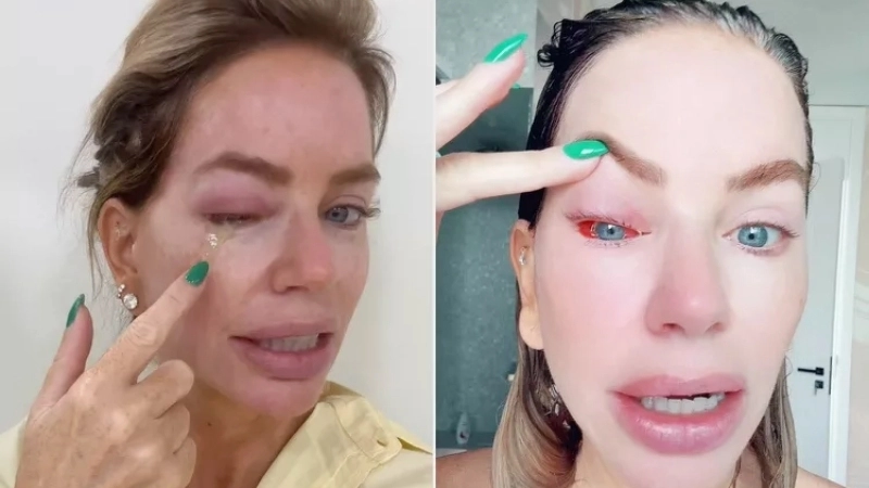 Biểu hiện sán chó trên da với các vệt di chuyển