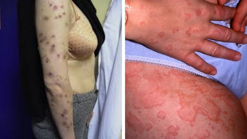 Hình ảnh nổi mẩn ngứa như sán chó trên da người bệnh