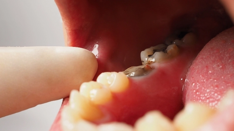 Hình ảnh mô tả tình trạng răng sâu vào tủy