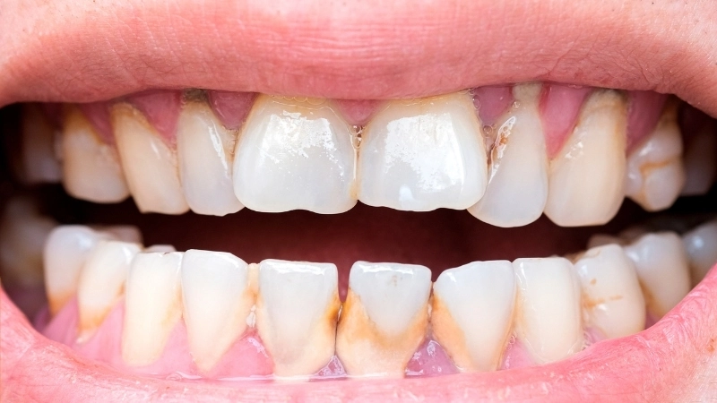 Quy trình trám răng sâu tại nha khoa