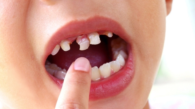 Kỹ thuật hàn răng sâu thẩm mỹ