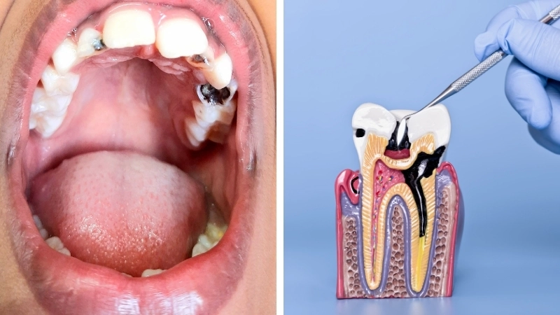 Tình trạng răng sâu bị vỡ và cách khắc phục