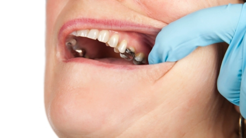 Mức độ sâu răng ở trẻ em và cách phòng tránh