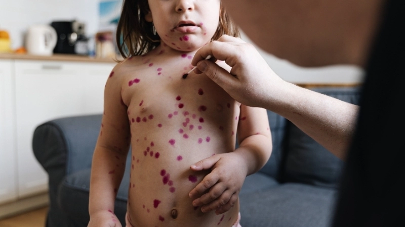 Hình ảnh nốt sởi khi bắt đầu xuất hiện ở vùng sau tai