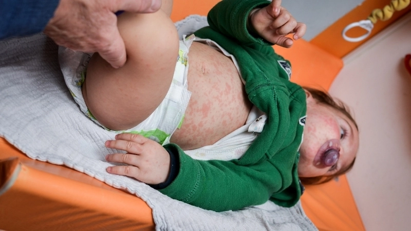 Tổng hợp các dấu hiệu bệnh sởi ở trẻ trong giai đoạn khởi phát