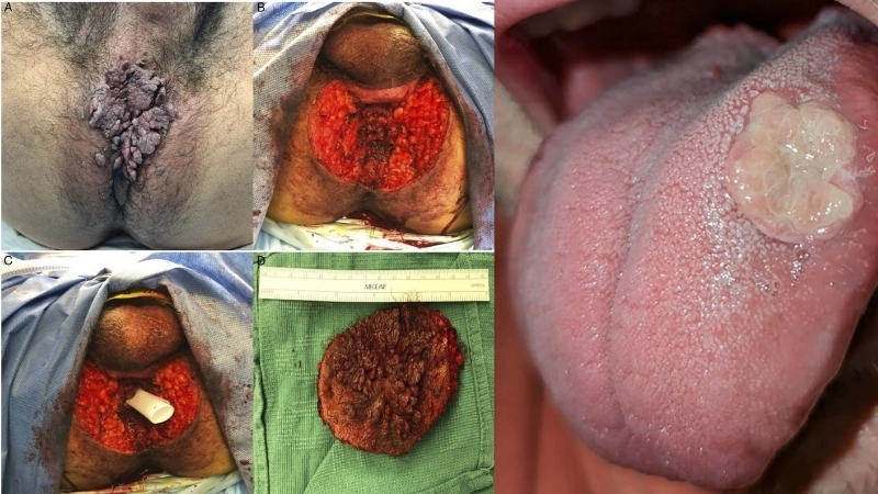 Cụm sùi đặc trưng trong hình ảnh của bệnh sùi mào gà ở nữ