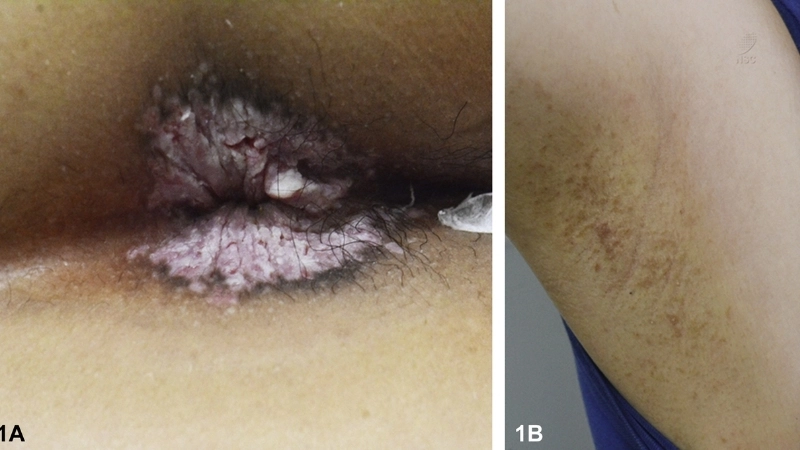 Hình ảnh bệnh sùi mào gà nhẹ khó nhận biết